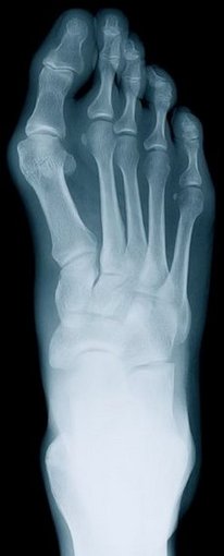 Trussville Podiatrist | Trussville Rheumatoid Arthritis | AL | Alabama Medical & Surgical Foot Center |
